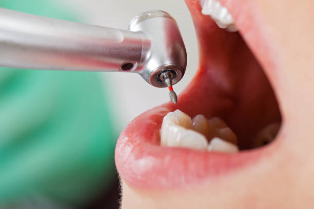 Best Knocked-Out Tooth (Avulsed Tooth) Treatment in Montecito, CA